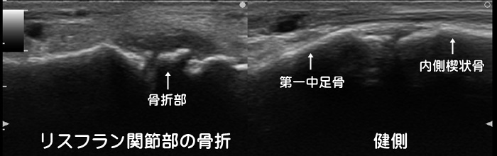 足趾の骨折