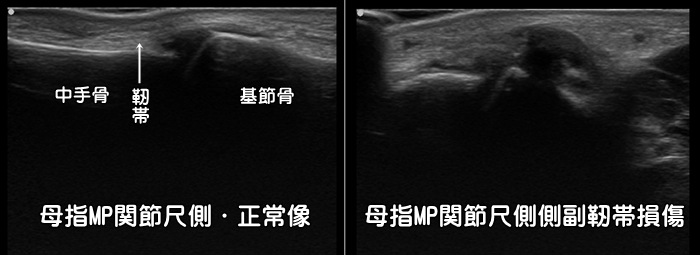 母指MP関節・尺側側副靭帯損傷