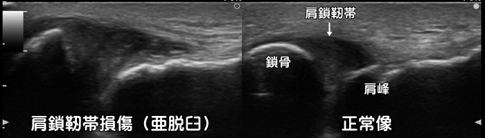 肩鎖靭帯損傷・肩鎖関節脱臼