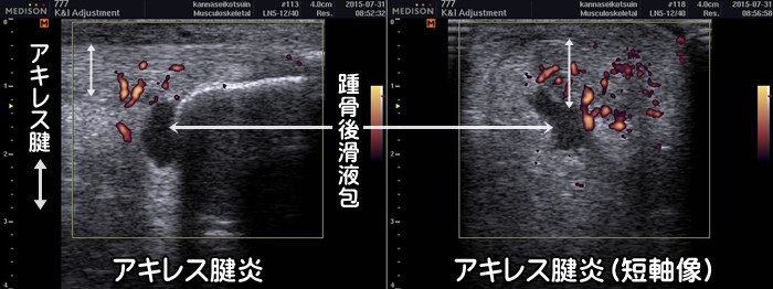 アキレス腱炎・周囲炎