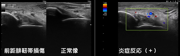 足関節捻挫・足首捻挫・前距腓靭帯損傷