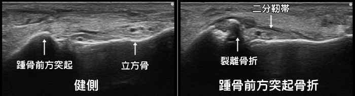 踵骨前方突起骨折・二分靭帯損傷・踵舟・踵立方・靭帯