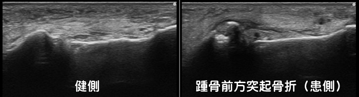 踵骨前方突起骨折・二分靭帯損傷・裂離骨折・剥離骨折