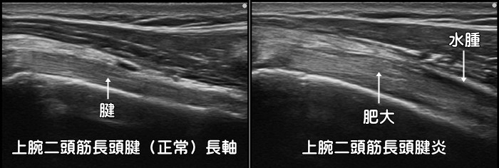 上腕二頭筋長頭腱炎・上腕二頭筋腱鞘炎