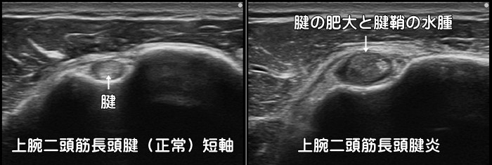 上腕二頭筋長頭腱炎・上腕二頭筋腱鞘炎