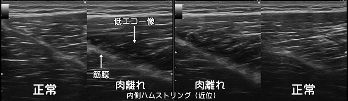 ハムストリング肉離れ・大腿二頭筋肉離れ