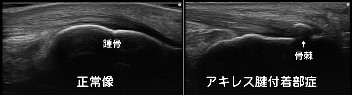 アキレス腱付着部症・踵骨棘