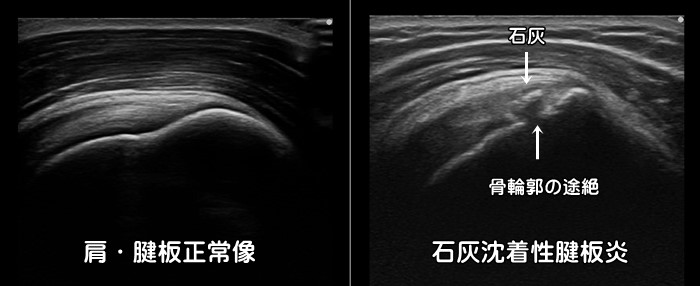 腱板・棘上筋・棘下筋・石灰沈着性腱板炎