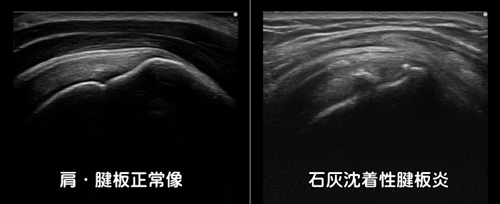 腱板・棘上筋・棘下筋・石灰沈着性腱板炎