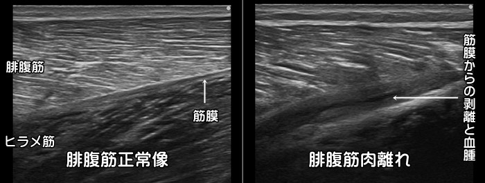 腓腹筋肉離れ・ふくらはぎ肉離れ