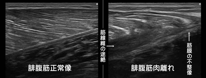 テニスレッグ・腓腹筋・ヒラメ筋