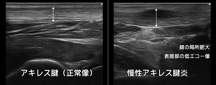 アキレス腱炎・周囲炎・しこり・ふくらみ