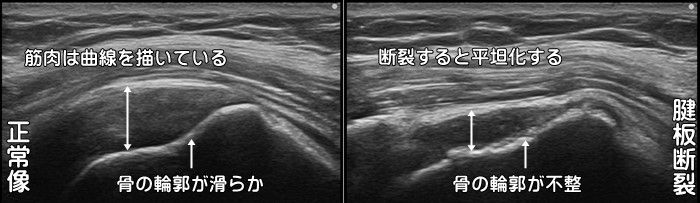 腱板断裂・棘上筋断裂・棘下筋断裂