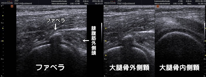 膝裏の痛み・ファベラ症候群