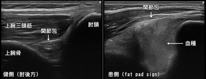 fat pad sign・上腕骨顆上骨折・橈骨頭頚部骨折