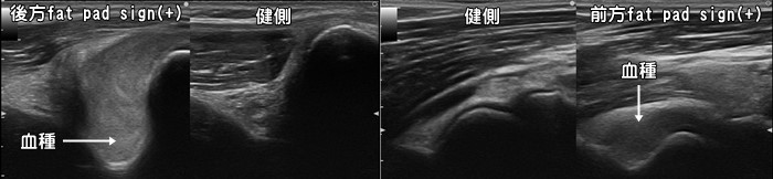 anterior・posterior・fatpadsign