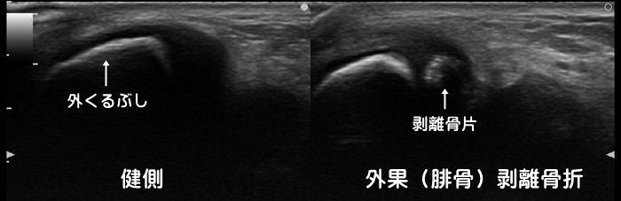 外果・腓骨・外くるぶし・剥離骨折・裂離骨折