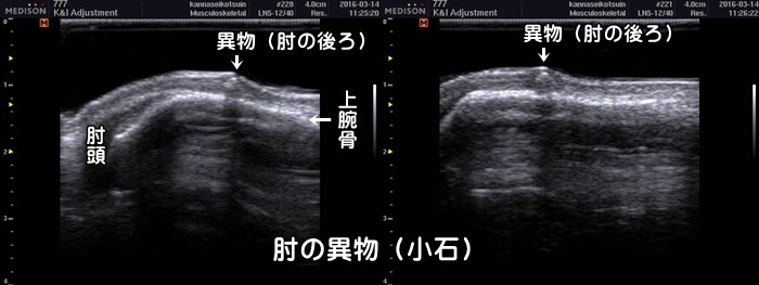 体内の異物・小石