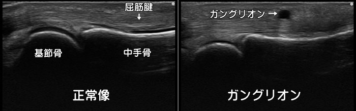 ガングリオン・指・手首・しこり