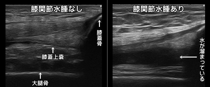 ⁮膝関節水腫・水が溜まる