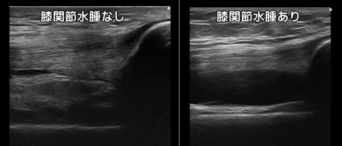 膝関節水腫・膝に水が溜まる