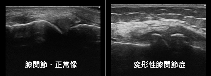 変形性膝関節症・膝の痛み