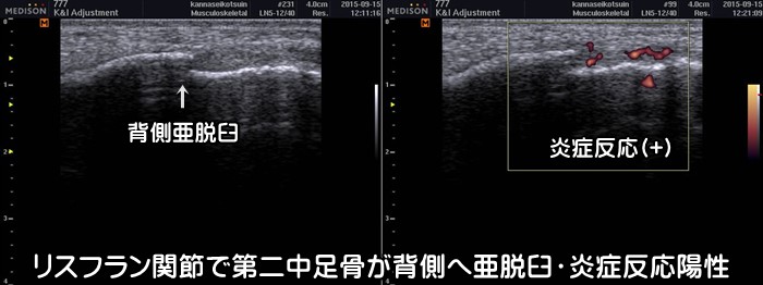 足の甲の痛み・捻挫