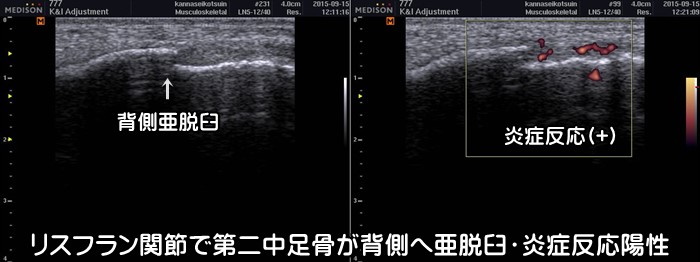 足の甲の痛み・捻挫