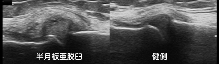 半月板亜脱臼・半月板損傷・断裂