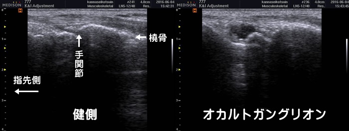 手首の痛み・手の甲の痛み・手をつくと痛い