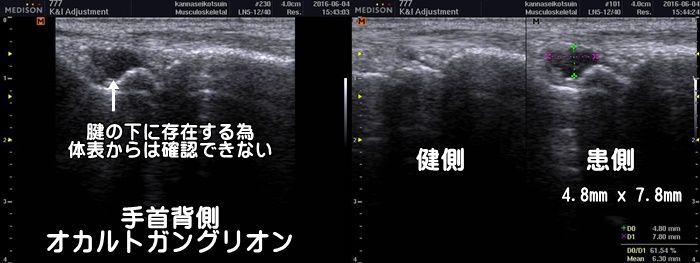 手首の痛み・手の甲の痛み・手をつくと痛い