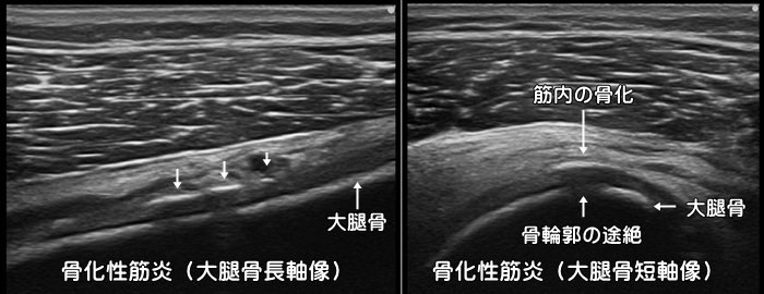 骨化性筋炎・異所性骨化・大腿部打撲・ももかん