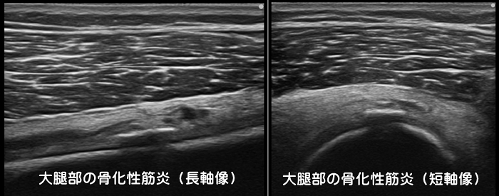 骨化性筋炎・異所性骨化・大腿部打撲・ももかん