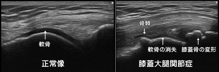 膝蓋大腿関節症・PFjointOA