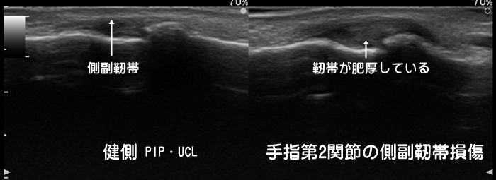 手指側副靭帯損傷・UCL損傷