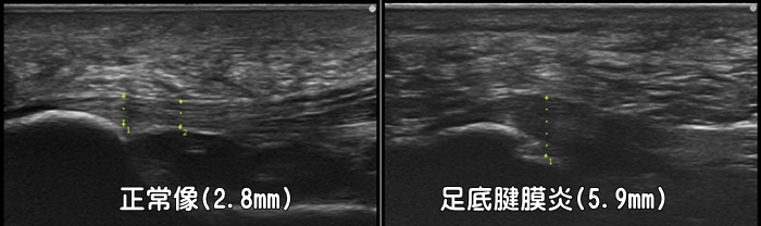 足底腱膜炎・足底筋膜炎・かかとの痛み