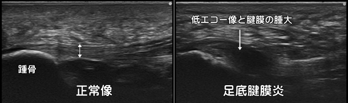 足底腱膜炎・足底筋膜炎・かかとの痛み