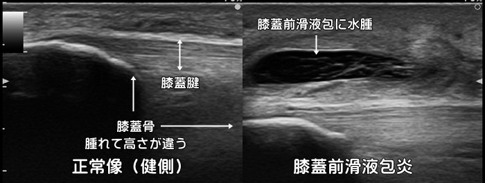 膝蓋前皮下包炎・膝蓋前滑液包炎・膝の腫れ