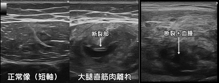 大腿四頭筋・大腿直筋・太もも肉離れ