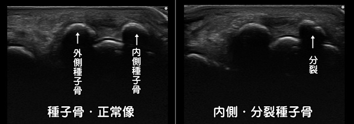 母趾種子骨障害・分裂種子骨