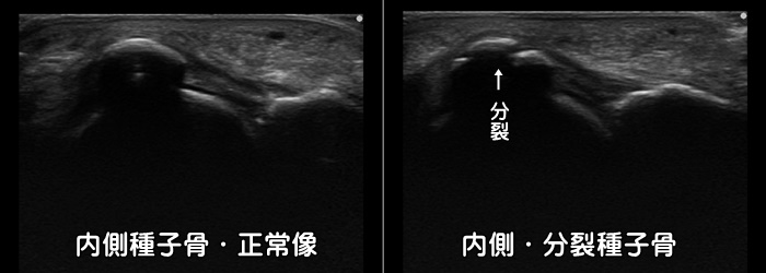 足の裏・親指の痛み