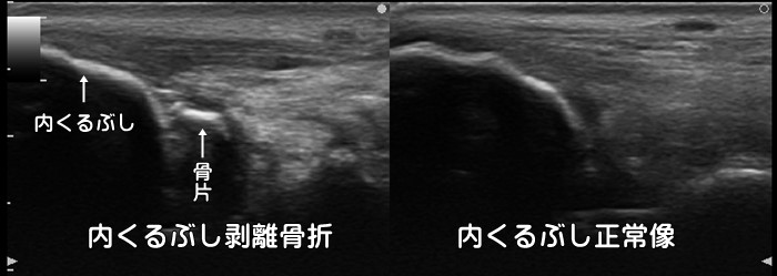 内果・脛骨・内くるぶし・剥離骨折・裂離骨折