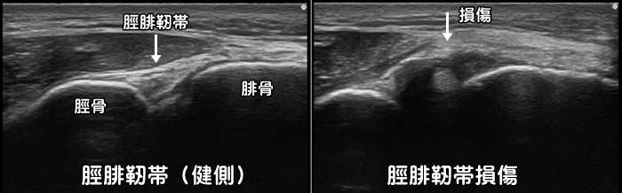 前下脛腓靭帯損傷・脛腓靭帯