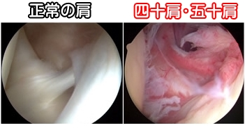 四十肩・五十肩・西院治療