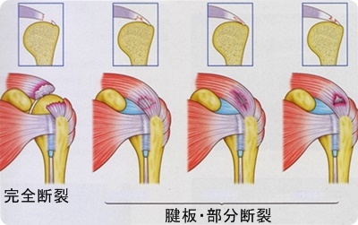 腱板損傷・腱板損傷・京都市