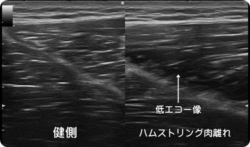 ふともも・ハムストリングス・肉離れ・にくばなれ