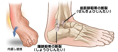 前 距 靭帯 くるぶし 腓 ハビリス診察室：外くるぶしが痛い！足首の捻挫の基本＃２