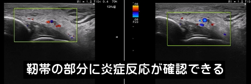 足首捻挫・炎症反応