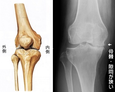 京都市中京区右京区下京区変形性膝関節症