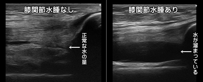 京都市中京区右京区下京区関節水腫